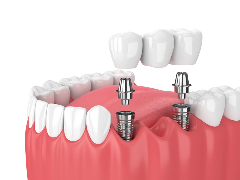 Dental Implants Securing A Bridge