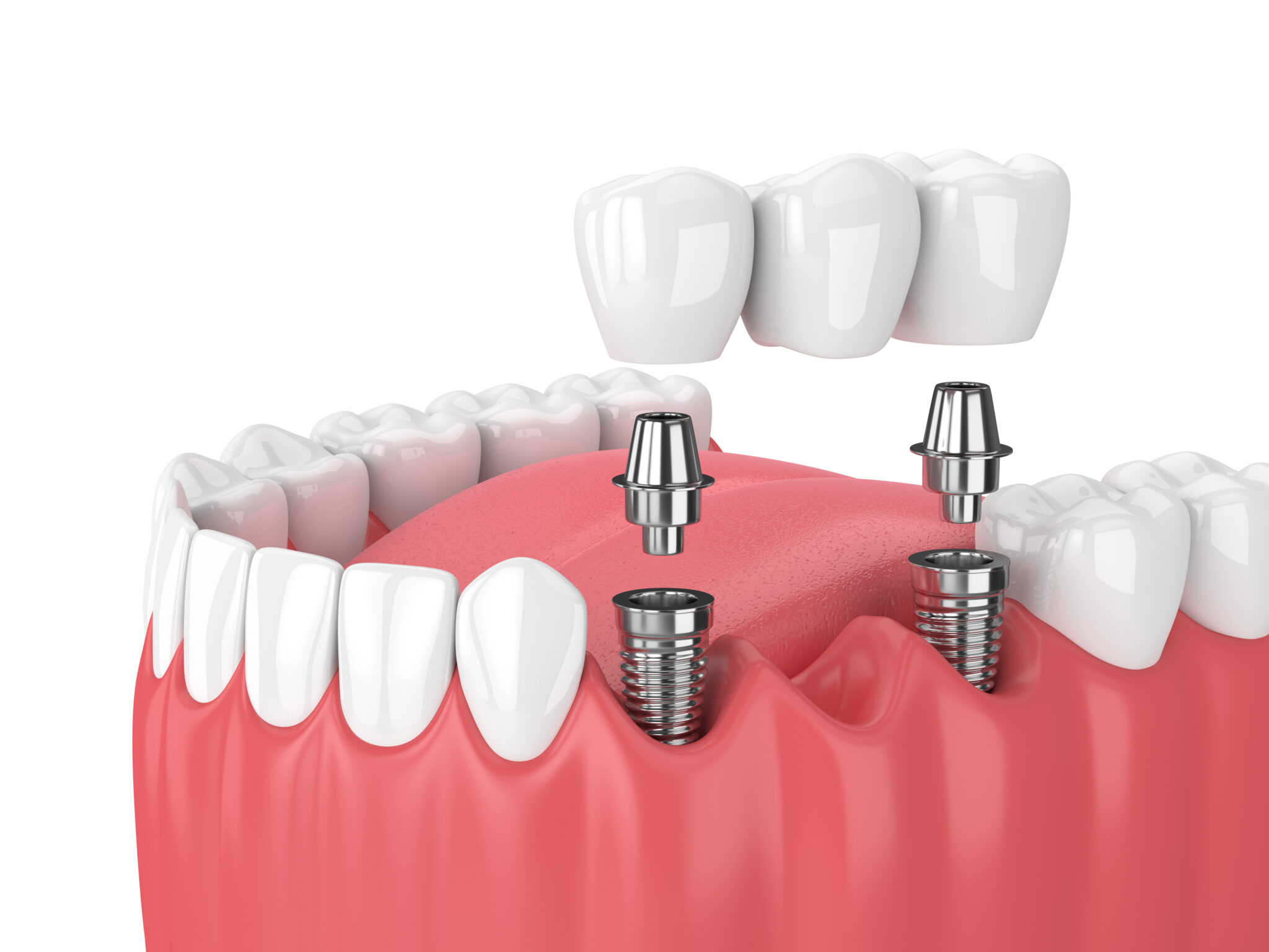 Replace Your Missing Tooth With A Dental Bridge Ankeny, IA