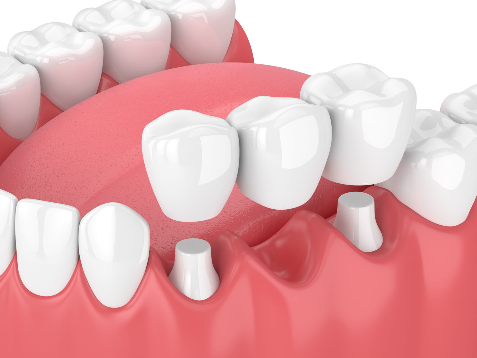 Dental Bridges Secure New Teeth For Your Smile Ankeny, IA