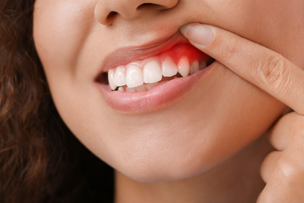 closeup of inflamed gums