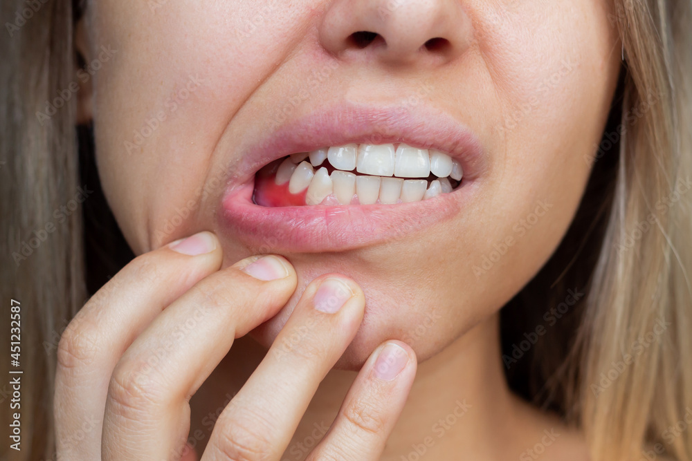 Dental Impressions Can Help Keep Your Gums Healthy