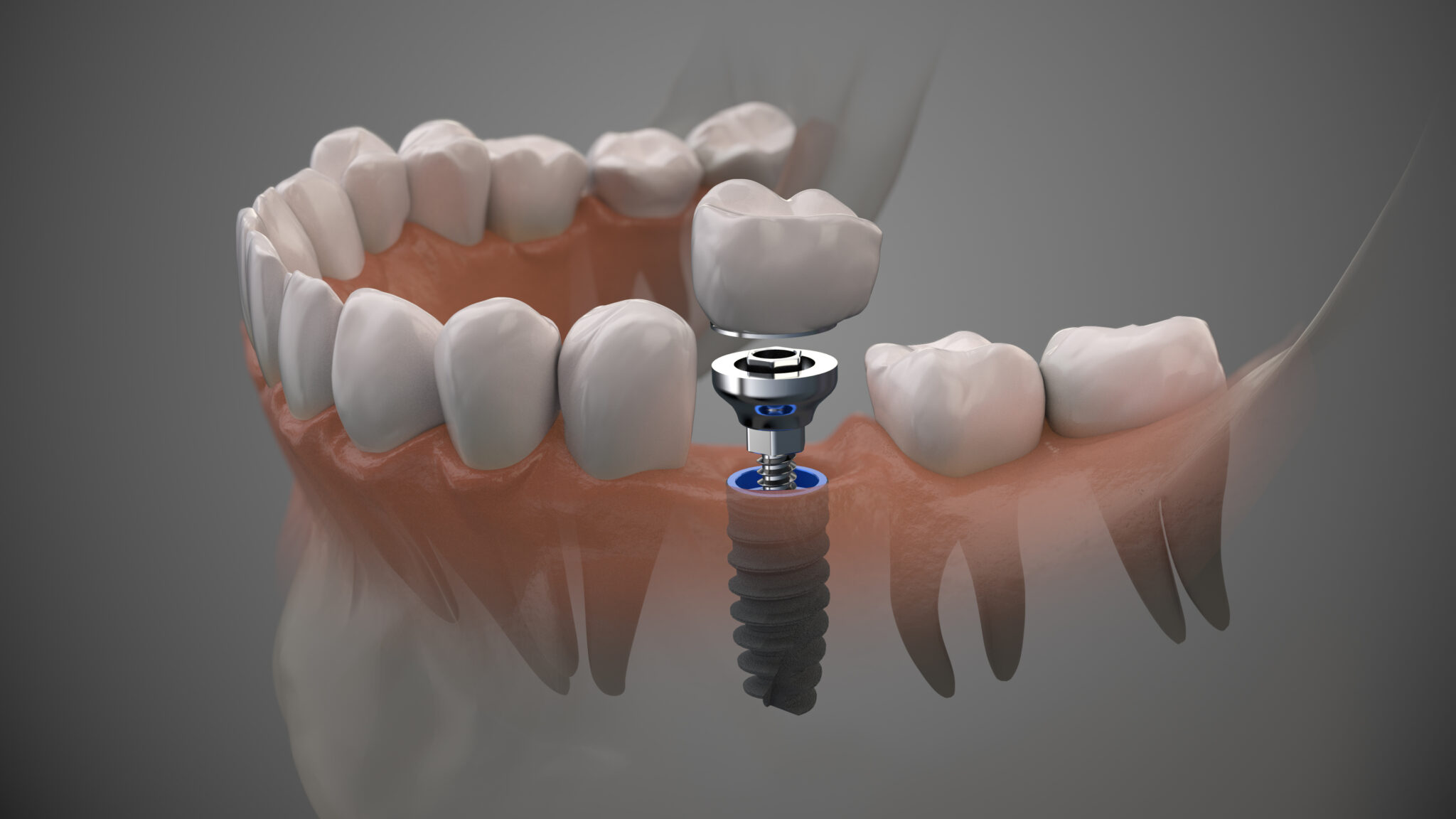A Sturdy Solution for A Broken Tooth Ankeny, IA
