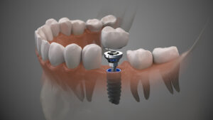 Dental impressions implant