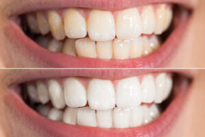 Dental impressions whitening