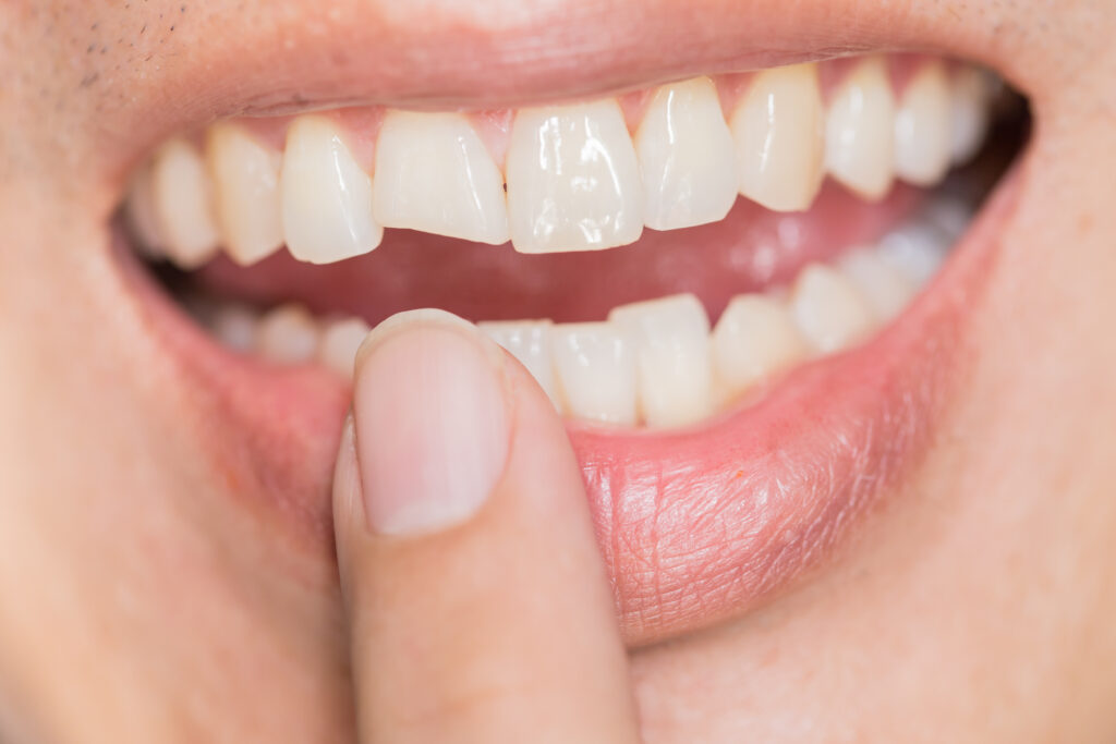 Dental Impressions offers restorations including crowns to repair damaged tooth