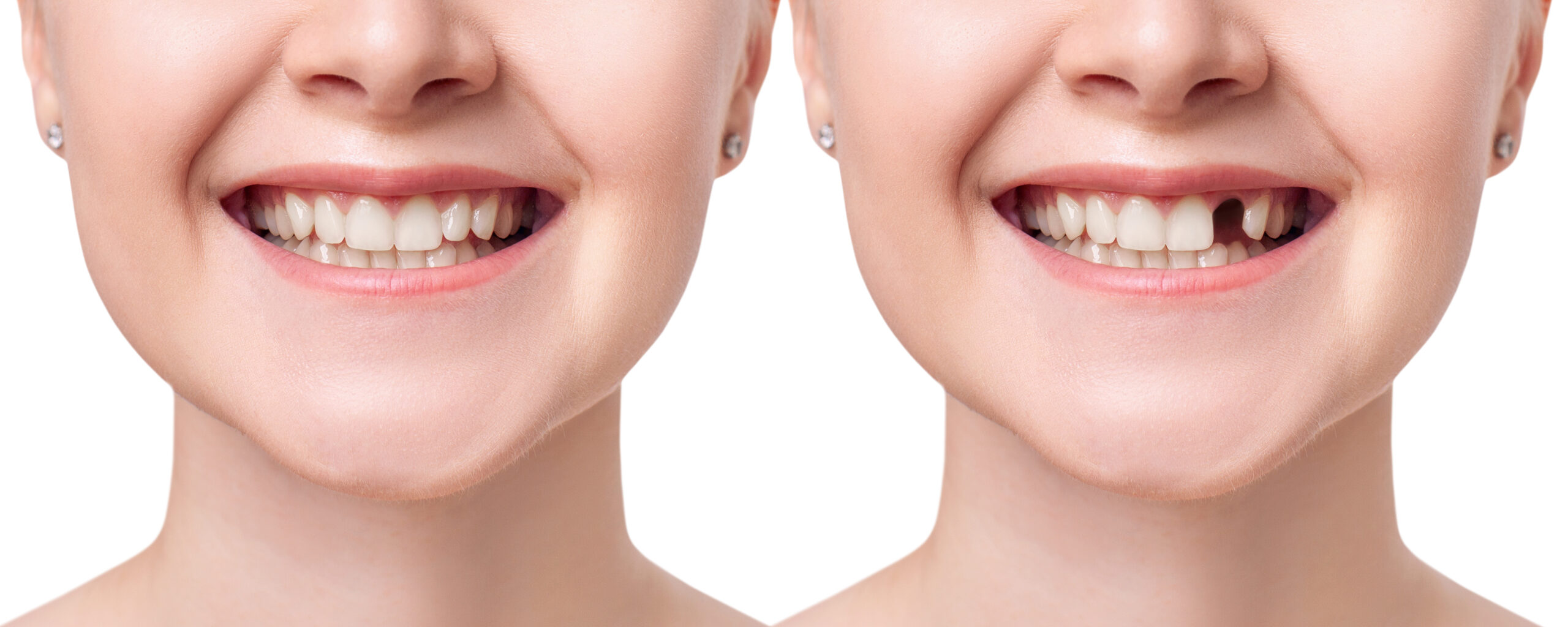 Restore Your Smile With Dental Implants Ankeny Ia