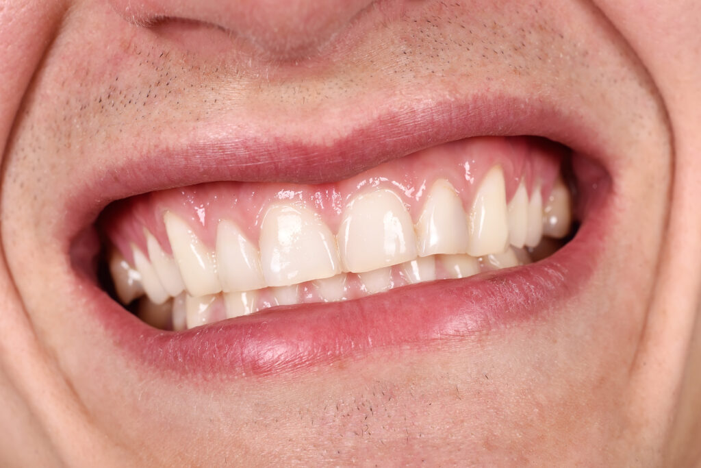 Dental Impressions in Ankeny, IA, offers treatment for bruxism