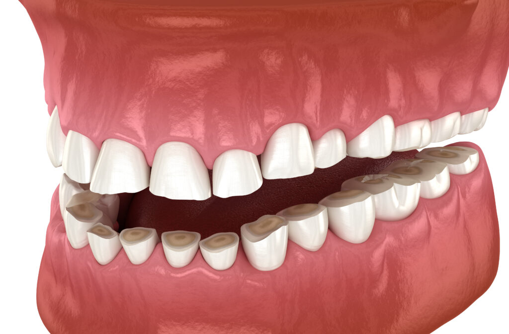 Ankeny, IA, dentist offers treatment for bruxism