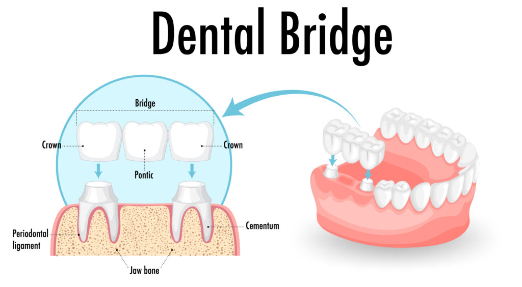 Ankeny, IA, dentist offers dental bridges for patients experiencing tooth loss