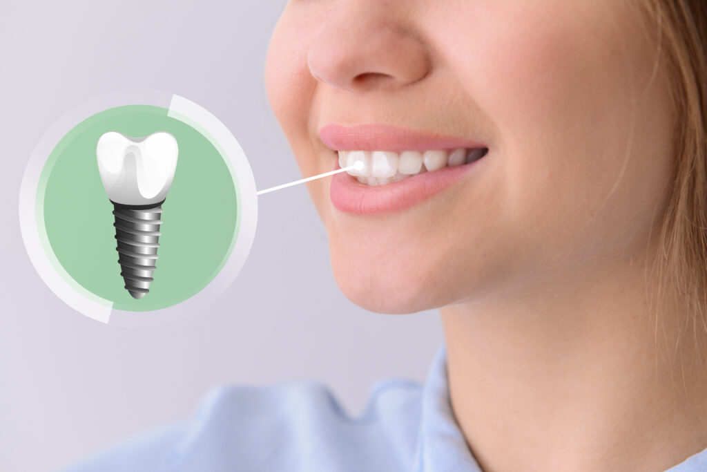 Ankeny, IA, dentist offers dental implants