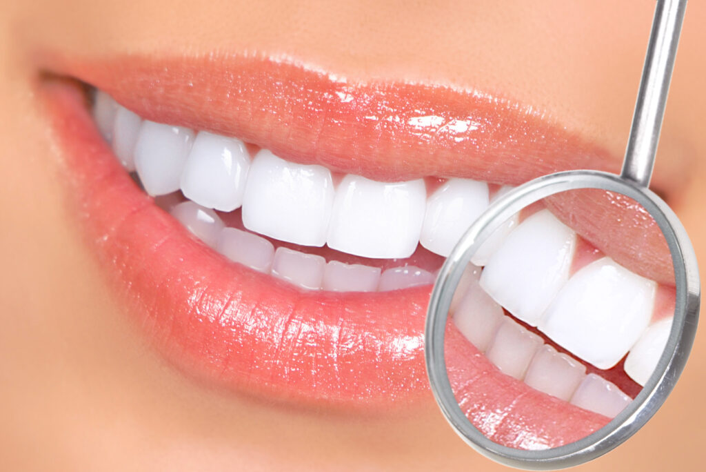 Ankeny, IA, dentist offers professional teeth whitening