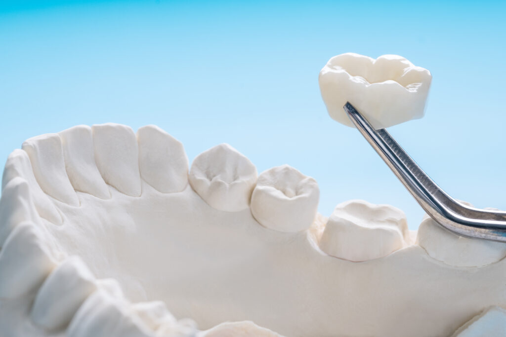 ankeny dental crowns