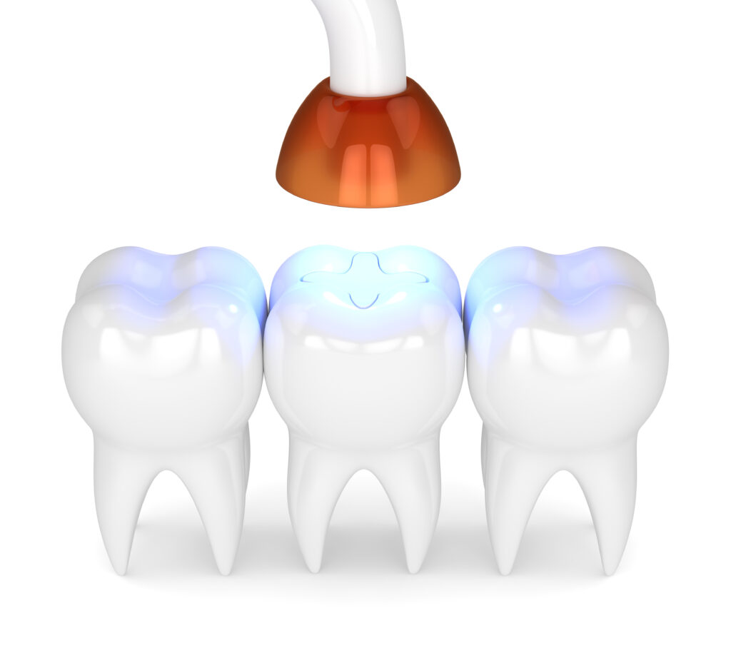 ankeny dental filling