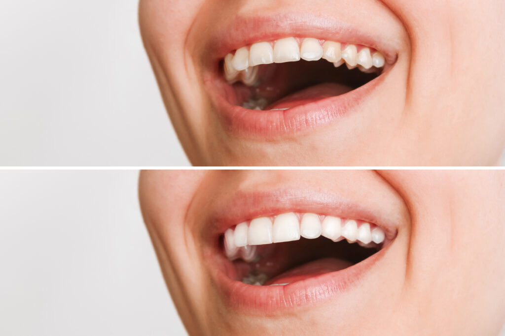 ankeny veneers