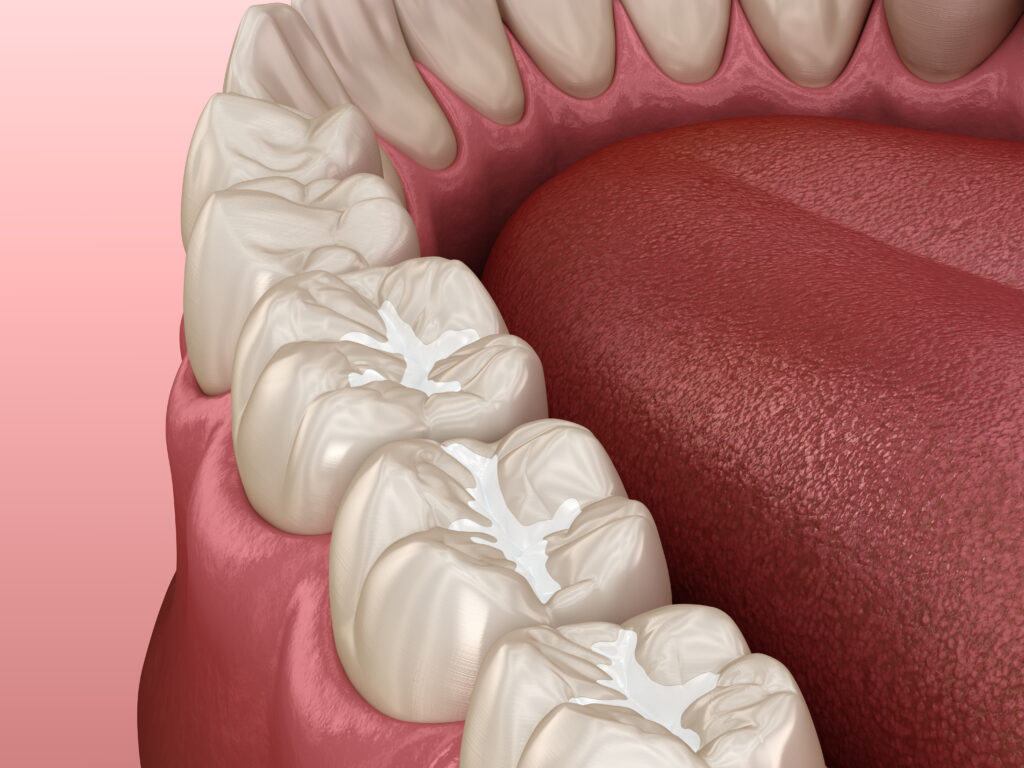 ankeny fillings