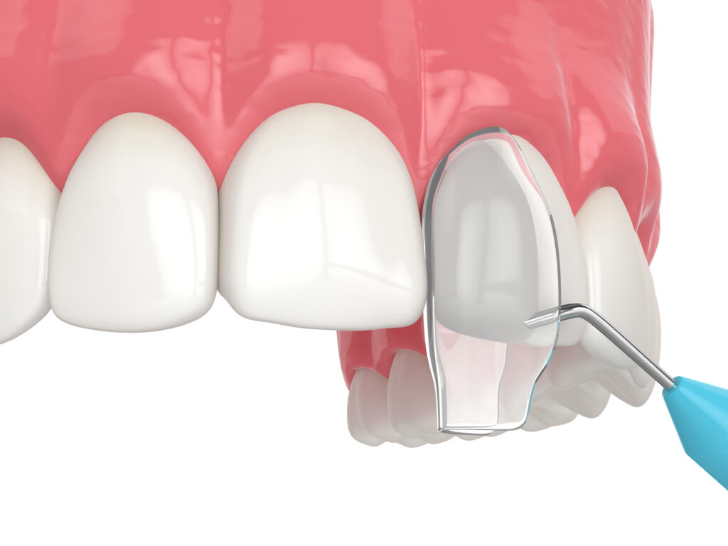 DENTAL BONDING ANKENY