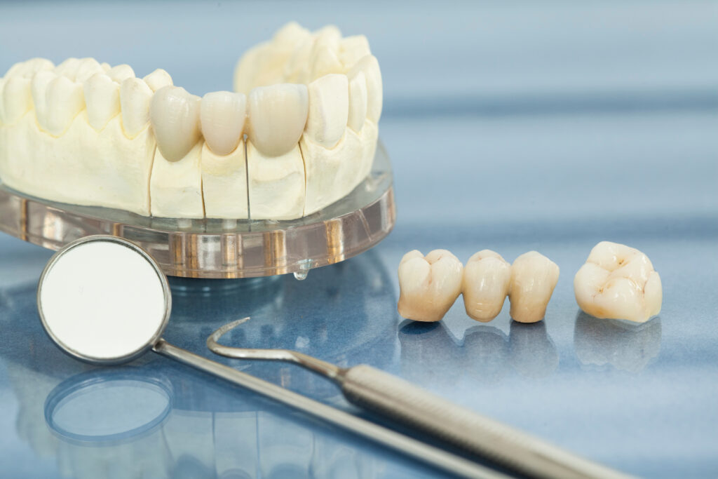 ankeny dental bridges