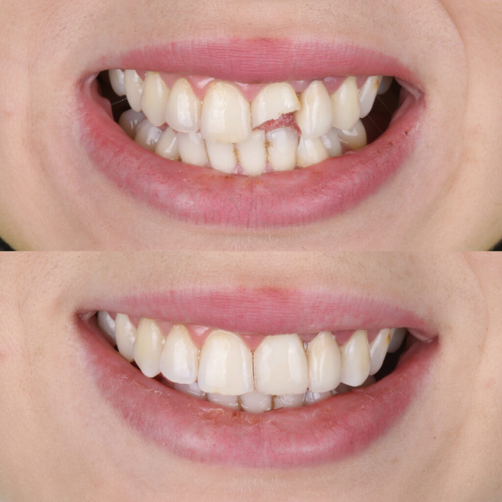 ankeny dental bonding