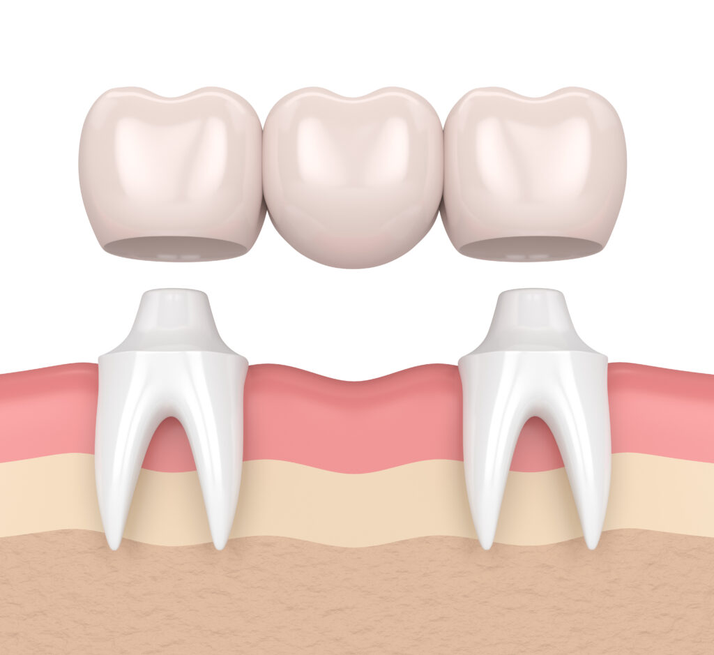 ankeny dental bridge