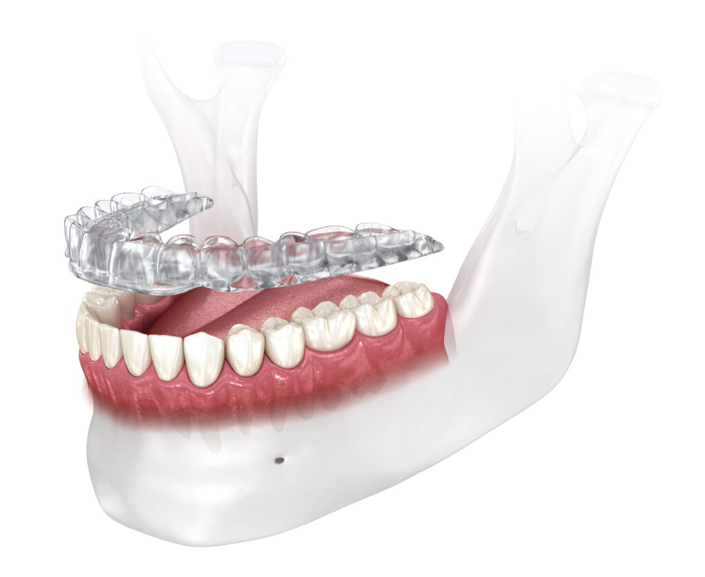 ankeny bruxism