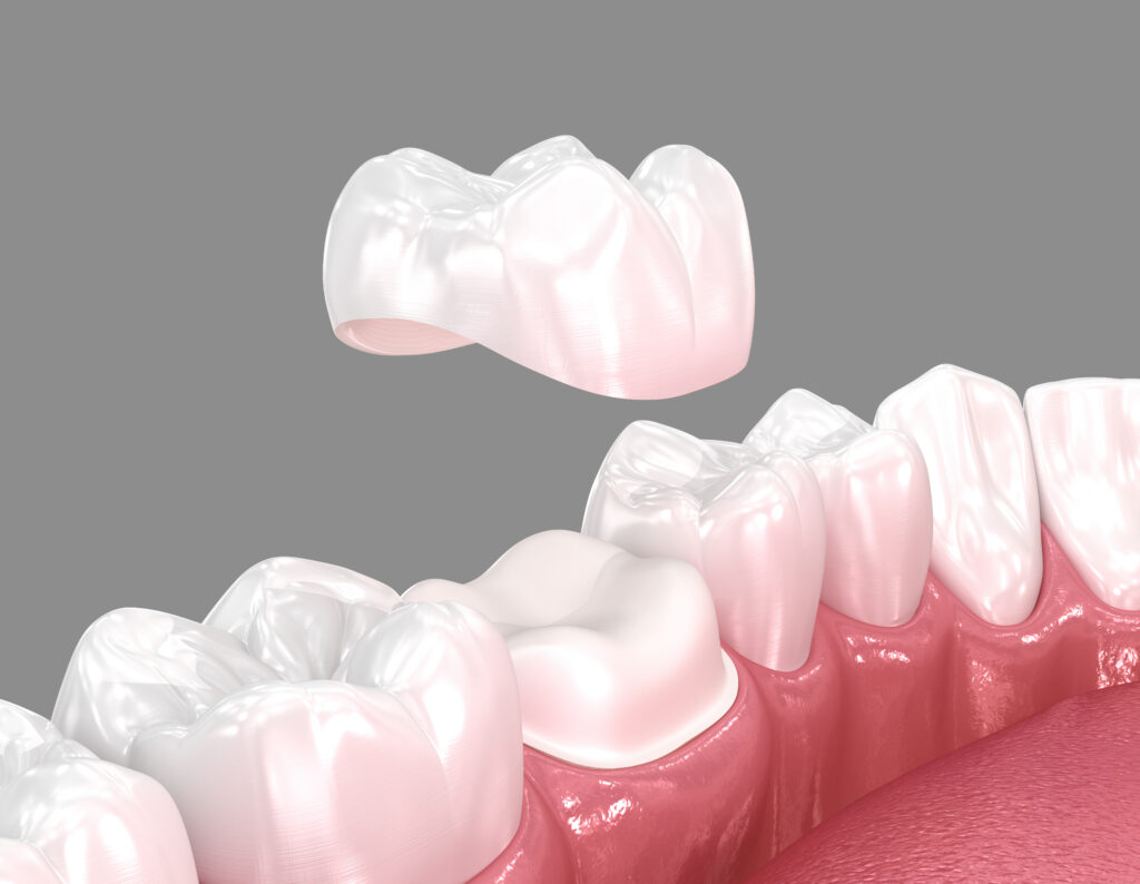 ankeny dental crowns