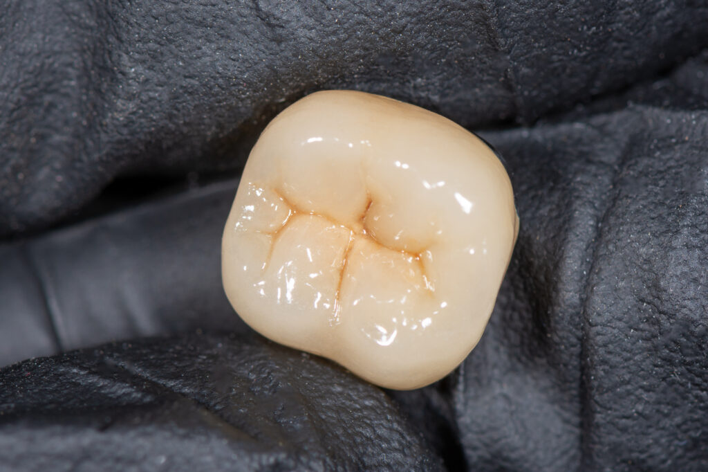 ankeny dental crowns