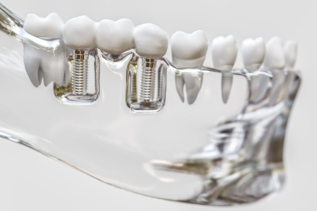ankeny dental bridge