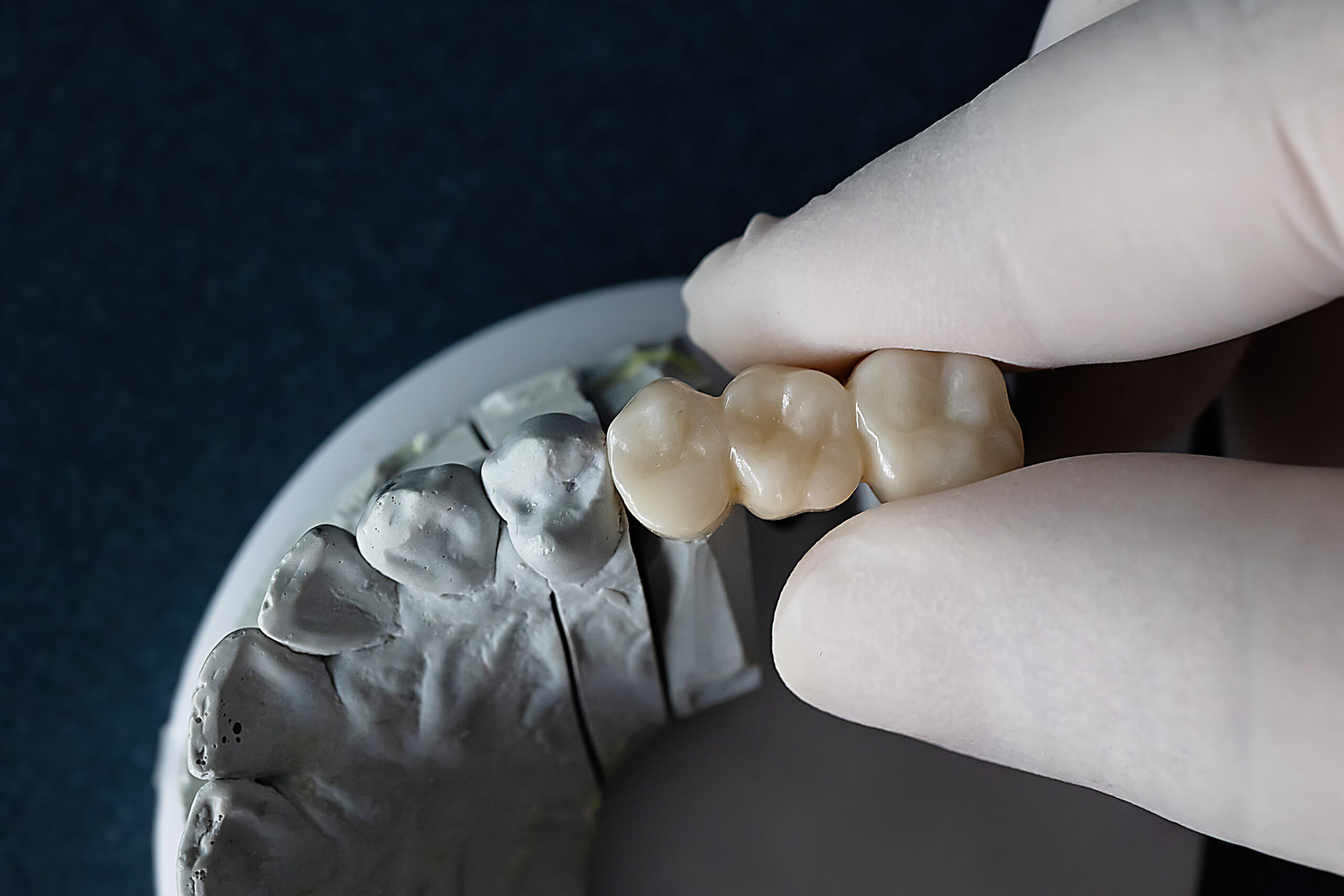 Creating And Placing A Lifelike Dental Bridge | Ankeny, IA