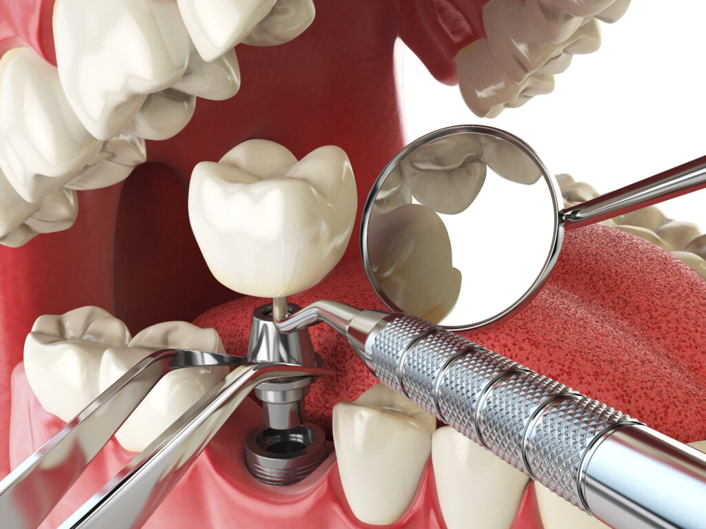 ankeny dental implants