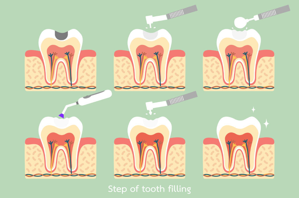 ankeny dental fillings