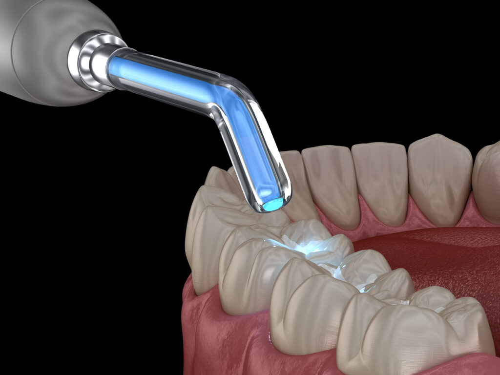 ankeny dental bonding