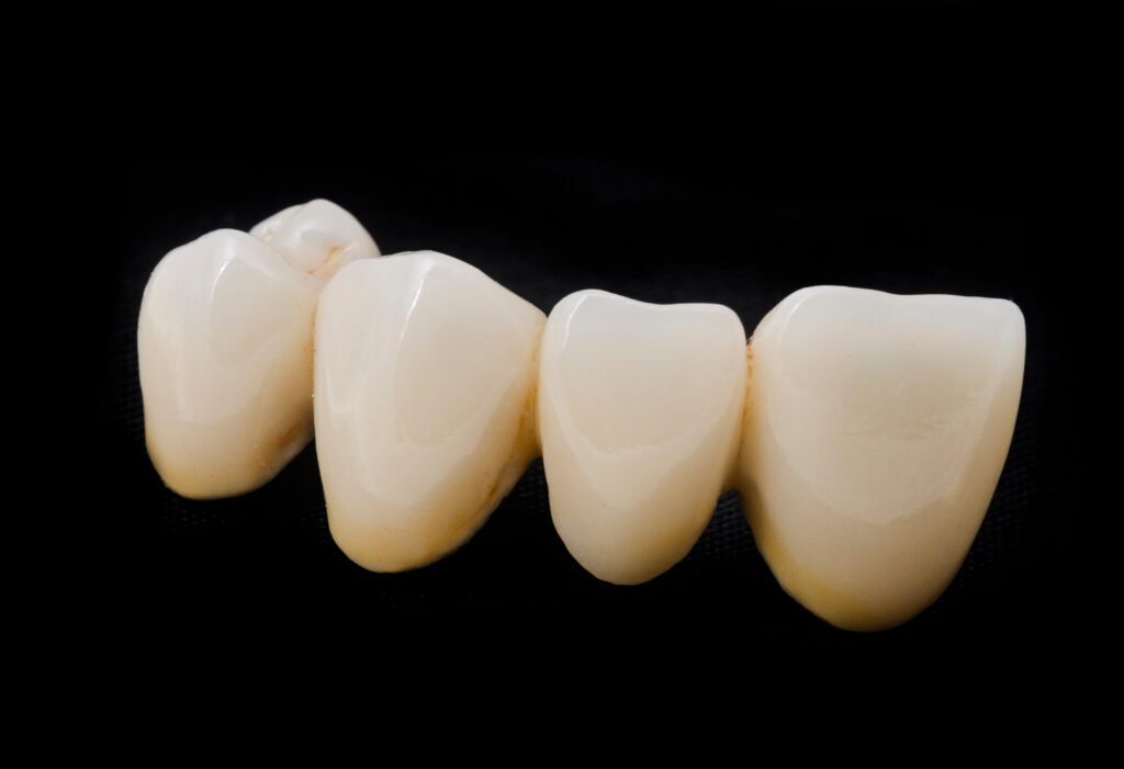 ankeny dental bridges