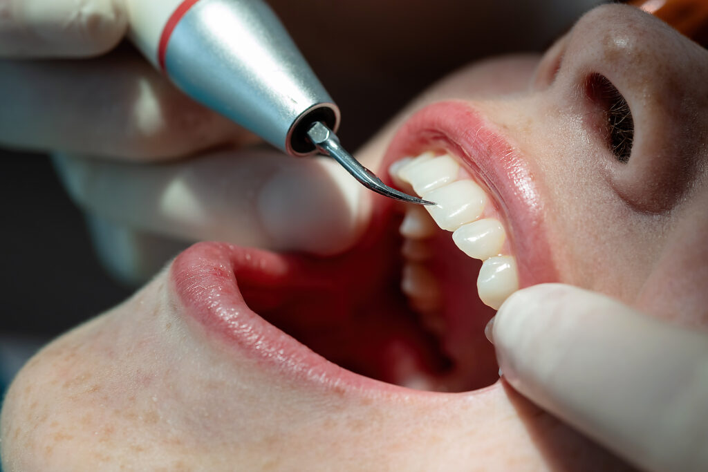 ankeny scaling and root planing