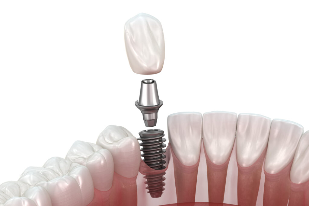 ankeny dental implants