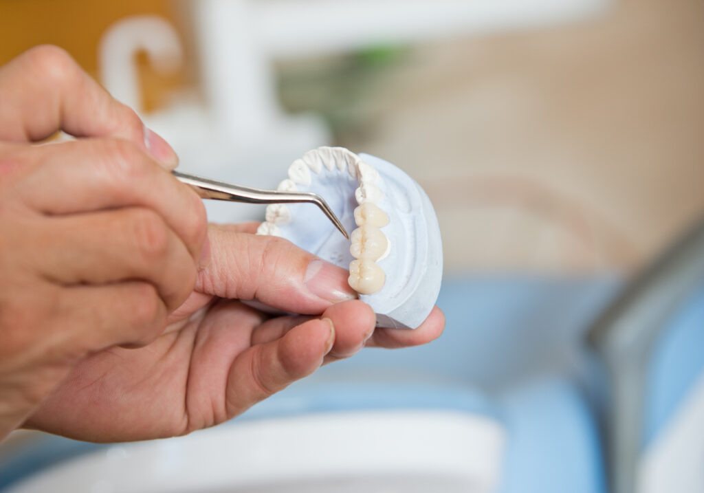 ankeny dental bridges