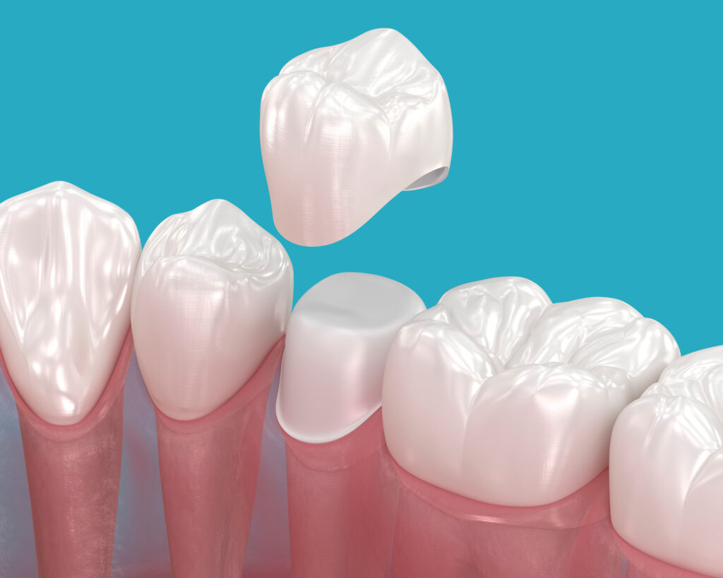 ankeny dental crowns