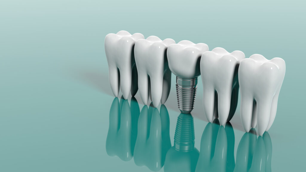 ankeny dental implants