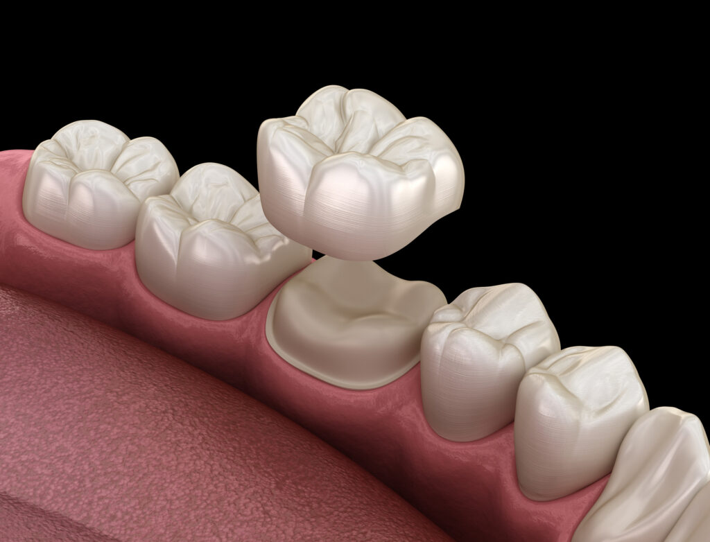 ankeny dental crowns