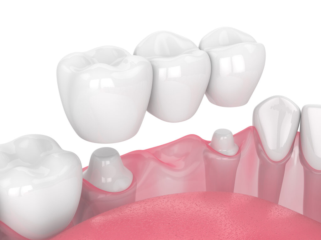 ankeny dental bridges