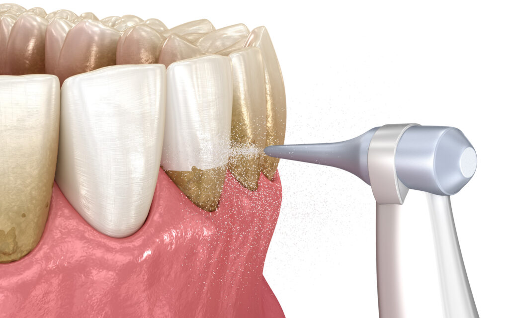 ankeny dental cleaning