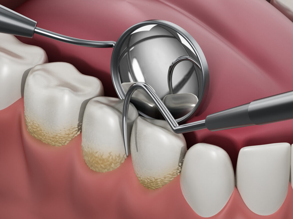 ankeny dental cleaning