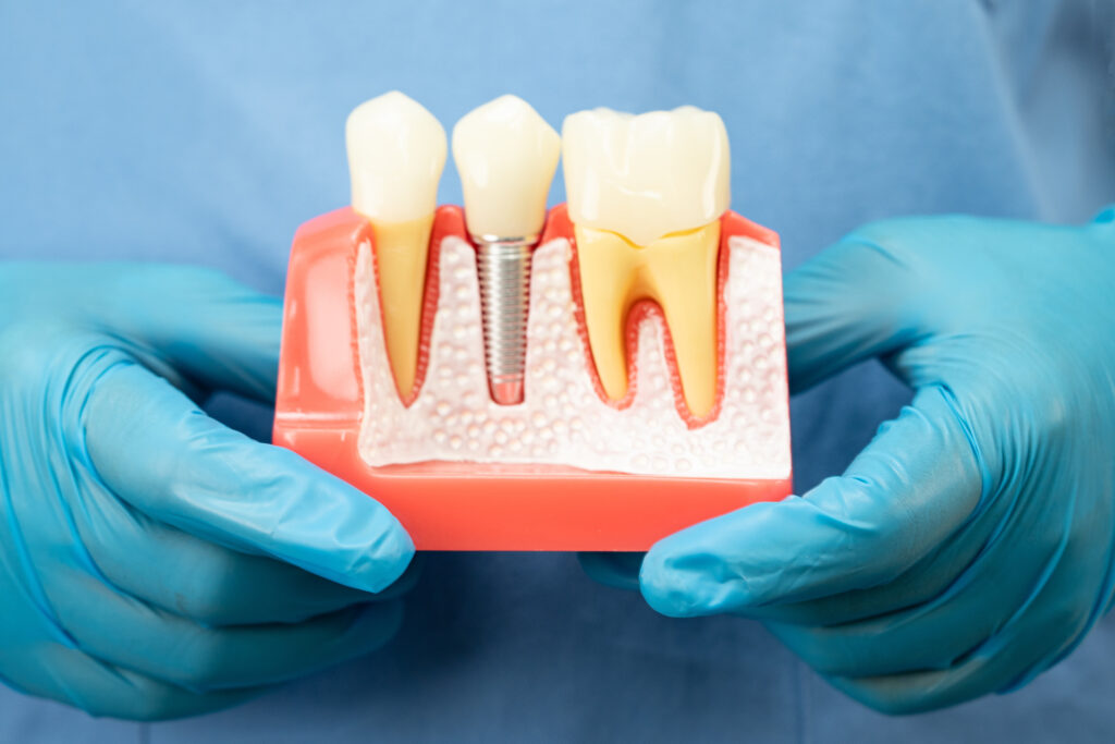 ankeny dental implants