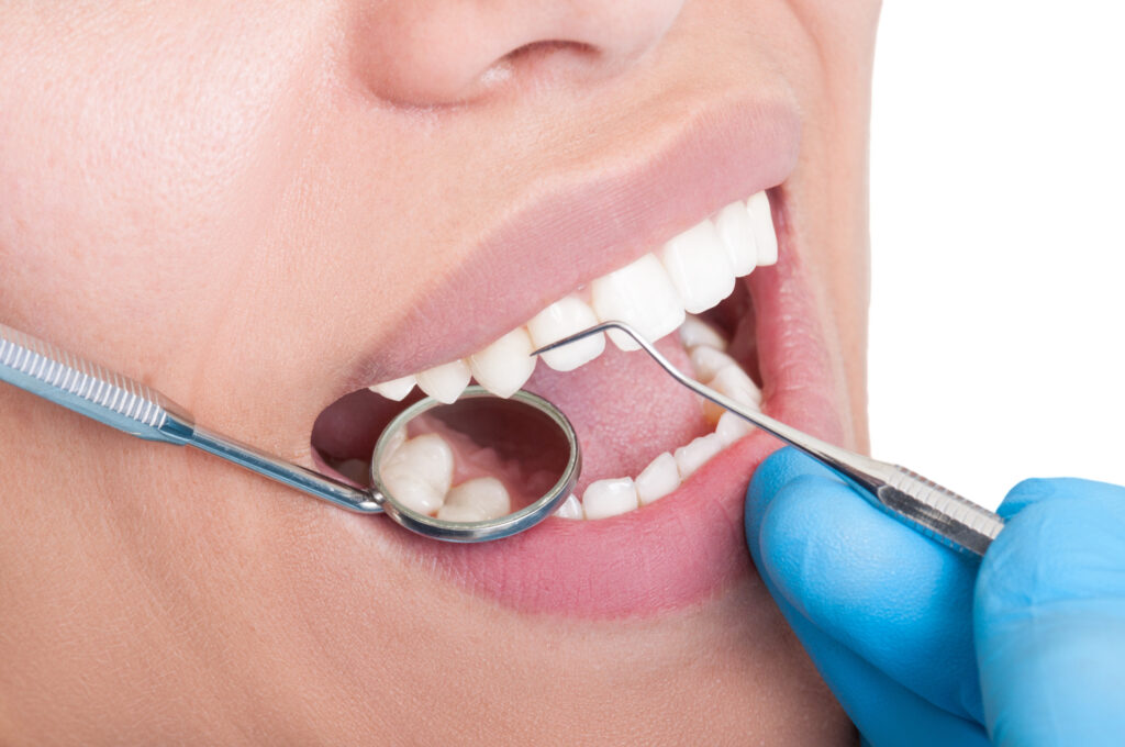 ankeny fillings