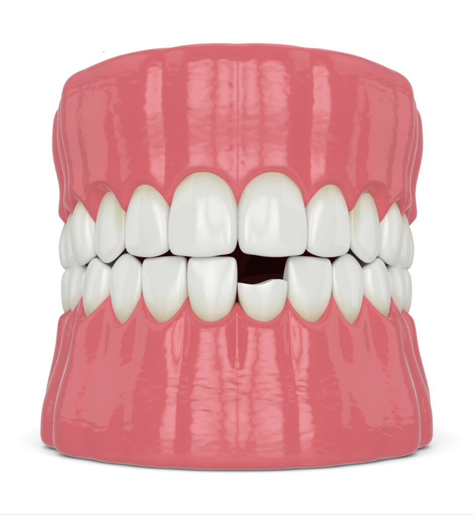 ankeny dental bonding