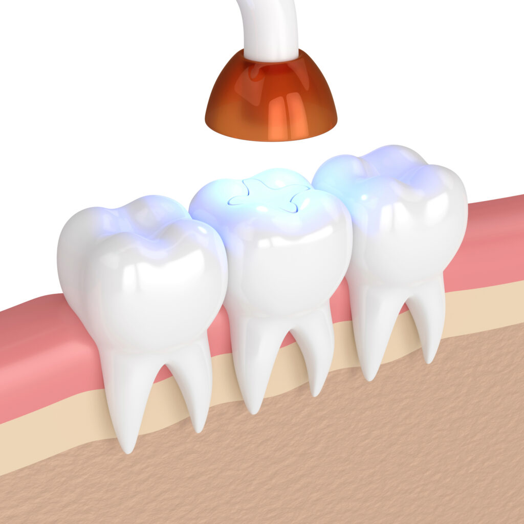 ankeny dental filling