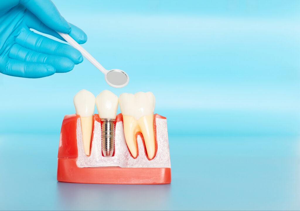 ankeny dental implants
