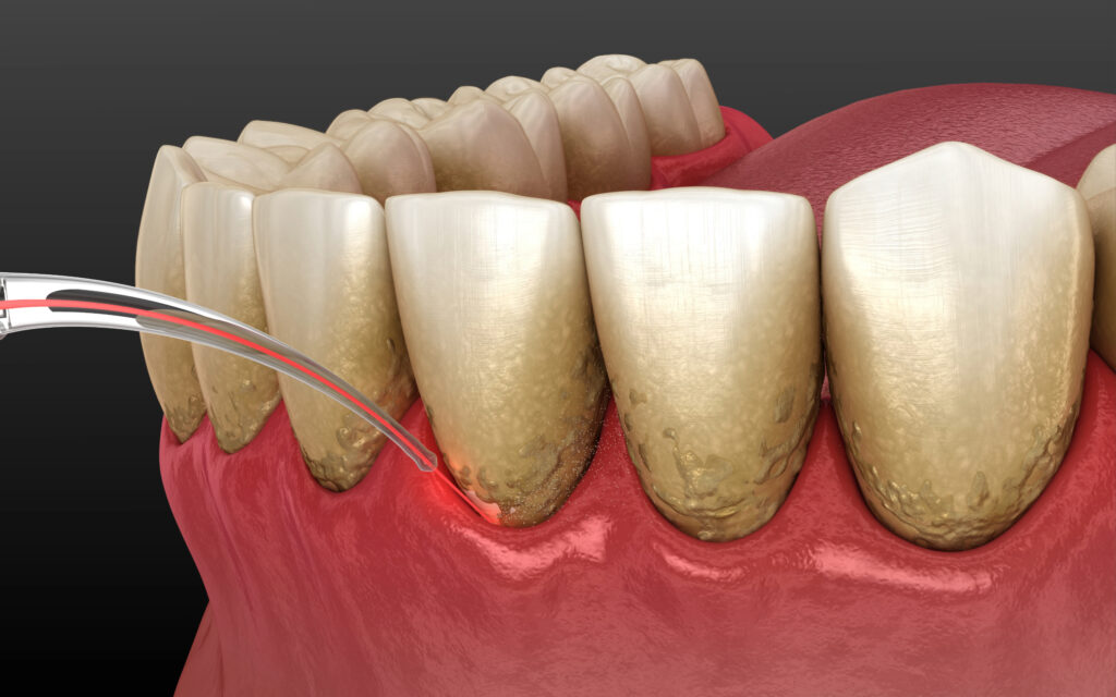 Encinitas laser treatment