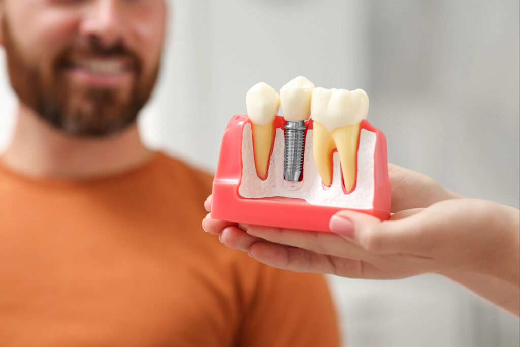 ankeny dental implants