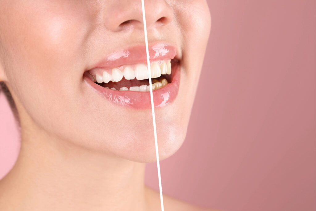 ankeny whitening