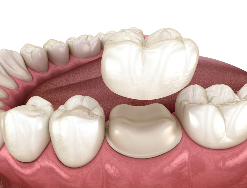 ankeny dental crown